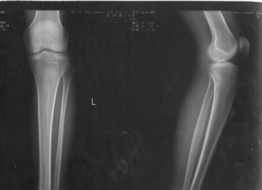 Good price 32 เซนติเมตร * 43 เซนติเมตร Xray กระดาษเลเซอร์ทางการแพทย์ฟิล์มการถ่ายภาพสำหรับ KND-DRYTEC-4000 KND-K ออนไลน์
