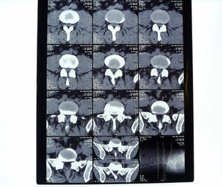 Good price 8in * 10in 14in * 17in ความหนาแน่นสูงทางการแพทย์ X-ray ฟิล์มความร้อนแห้ง ออนไลน์