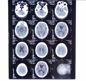 Good price 11in * 14in X-ray ฟิล์มถ่ายภาพทางการแพทย์แห้ง KND-A สำหรับ AGFA 5300, 5302, 5500, 5502, 3000 ออนไลน์