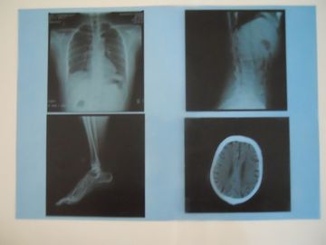 Good price KND-A ฟิล์มหมอกแห้งทางการแพทย์สำหรับการตรวจ X-ray บน AGFA 5300/5302/5500 ออนไลน์